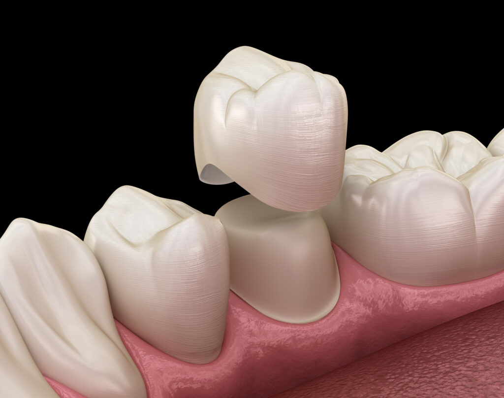 Dental Crowns