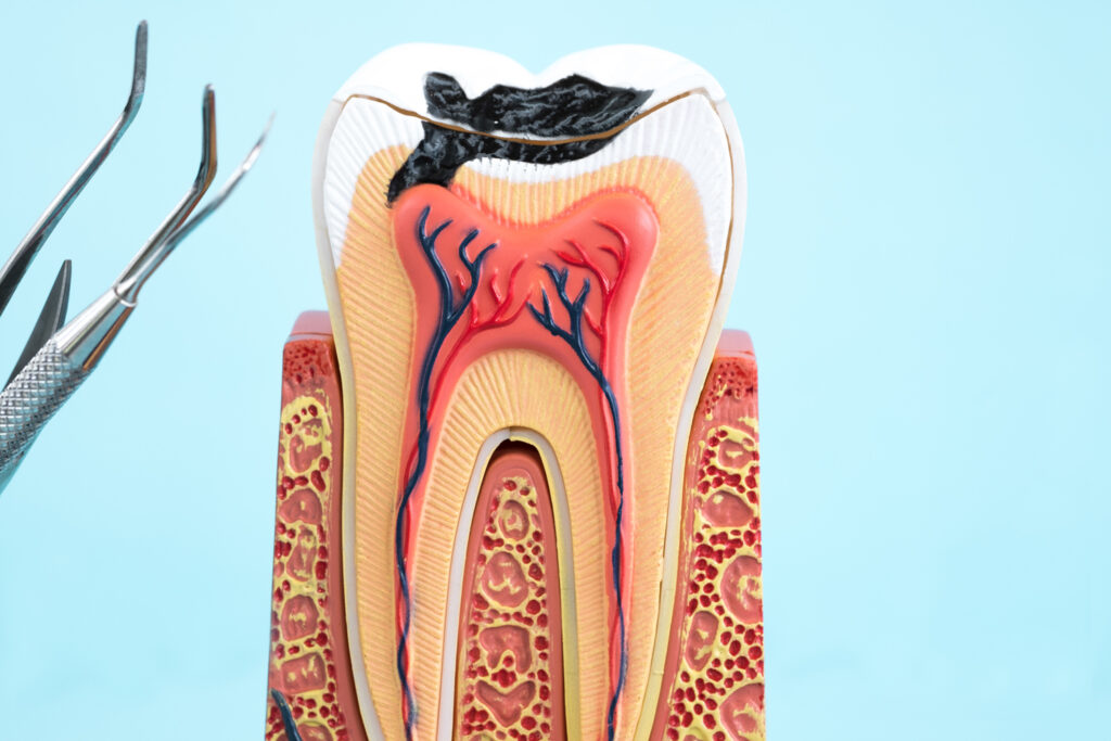 Root Canals