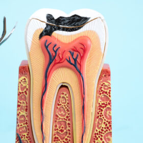 Root Canal
