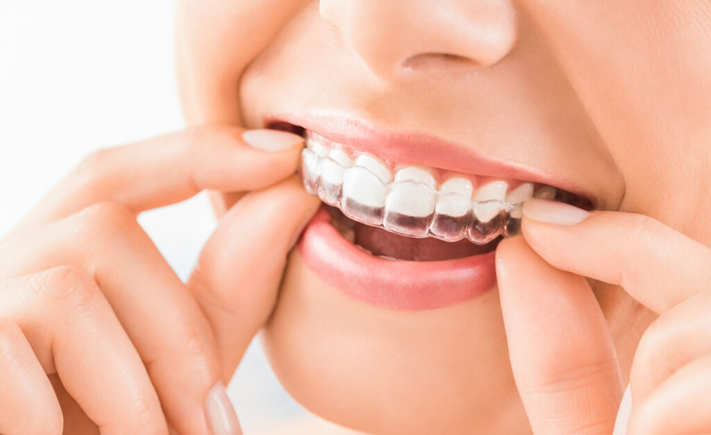 Invisalign® Treatment at Aqua Dental Studio in Coral Springs, FL