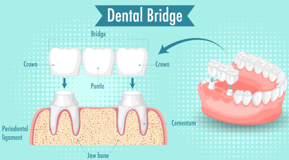Illustration showing how a dental bridge replaces a missing tooth, with labeled parts including crowns, pontic, and supporting structures.