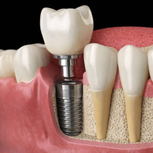 3D rendering of a dental implant with the screw, abutment, and crown shown in the jaw.