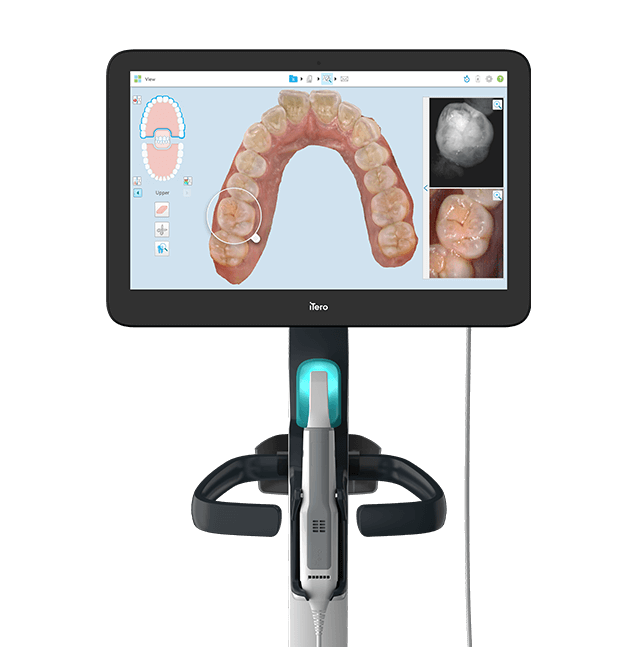 iTero intraoral scanner displaying a 3D digital model of the upper teeth with one tooth highlighted and detailed close‑up views on the side.