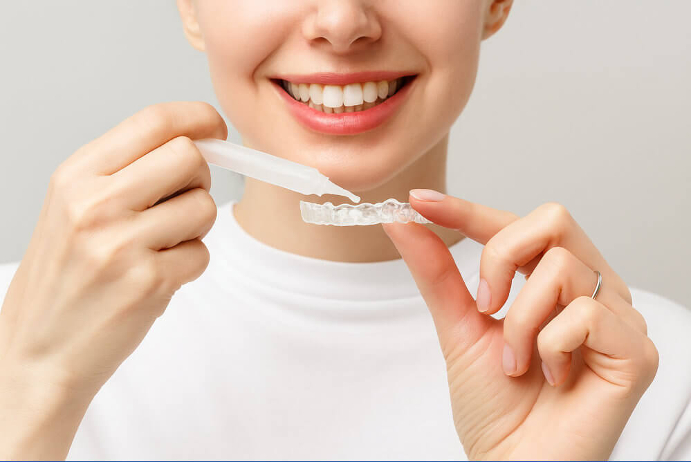 Smiling person applying take-home whitening gel to a clear dental tray.