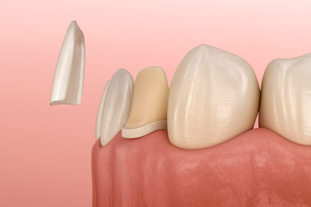 Prepared front tooth with a thin dental veneer hovering in front, showing the inner surface and fit.